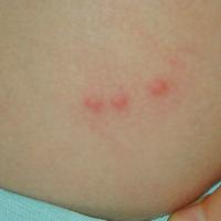 
	Papular urticaria - insect bites

	A very…
