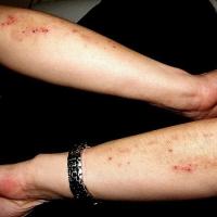 
	Dermatitis herpetiformis

	Copied with kind…