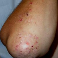 
	Dermatitis herpetiformis
	&nbsp;