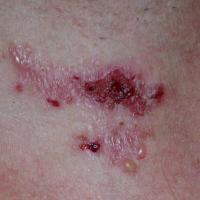 
	Dermatitis herpetiformis, close-up of previous…