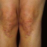 
	Dermatitis herpetiformis

	Copied with kind…