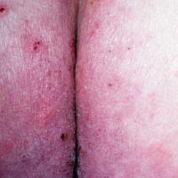 
	Dermatitis herpetiformis - bottom