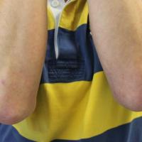 Dermatitis herpetiformis four weeks after…