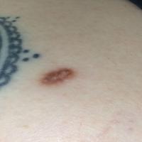 A flat dermatofibroma on the shoulder…