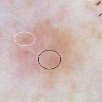 Dermoscopic appearance of previous figureWhite…