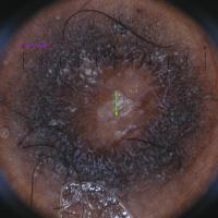 Dermoscopic appearance of…