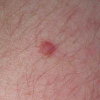 DermatofibromaCopied with kind permission from…