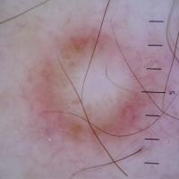 Dermoscopic appearance of previous…