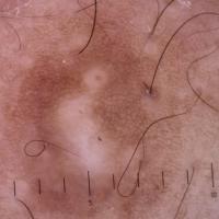 Dermoscopic appearance of previous figure&nbsp;In…