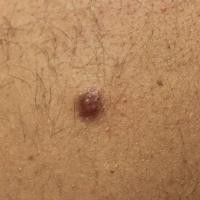 DermatofibromaCopied with kind permission from…