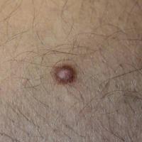 DermatofibromaCopied with kind permission from…