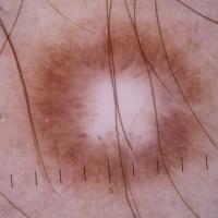 Dermoscopic appearance of previous figureA…