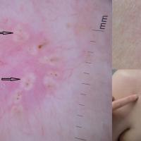Dermatofibroma with sebaceous gland hyperplasia…