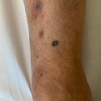 Dermatofibroma
