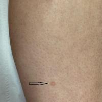 Dermatofibroma - multiple lesions are…