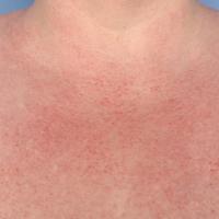 
	Dermatomyositis

	Early signs in a middle-aged…