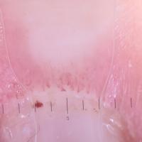 
	Nailfolds - dermoscopy

	Enlargement and…