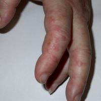 
	Dermatomyositis and&nbsp;Gottron's…