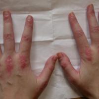
	Dermatomyositis

	In a young female