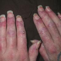 
	Dermatomyositis secondary to breast cancer