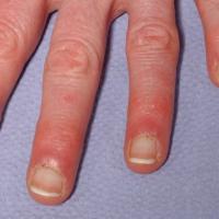 
	Dermatomyositis with nailfold changes
