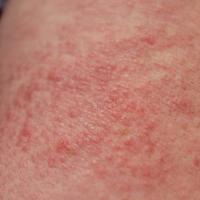 
	Close-up of previous image - papular morphology