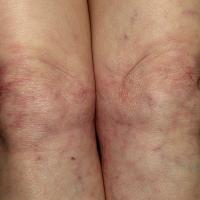 Dermatomyositis&nbsp;and livido…