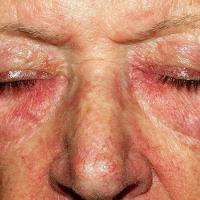 
	Dermatomyositis secondary to carcinoma of the…