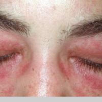 
	Same patient as previous image