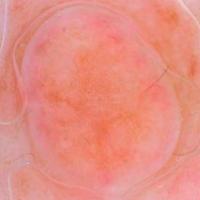 
	Dermoscopic image of the previous image