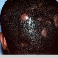 Dissecting cellulitis