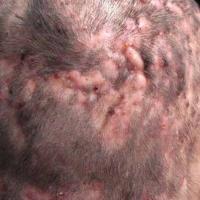 Dissecting cellulitis 