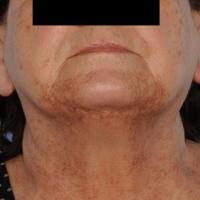 
	Lichenoid eruption to ACEI