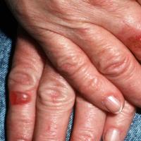 
	Pseudoporphyria
	
	Fragile blisters on…