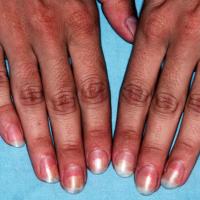 
	Photo-onycholysis