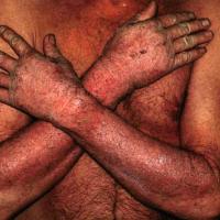 
	Photodermatosis: drug-induced
	
	Involvement…