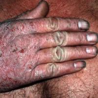 
	Close up of figure 3

	Note the eczematous…