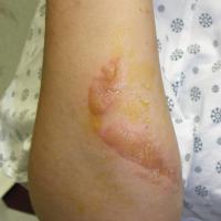 
	Phytophotodermatitis

	Classical streaky…