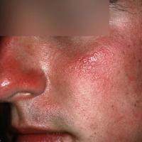
	Photodermatosis -&nbsp;doxycycline