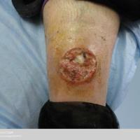 
	Ecthyma secondary to staphylococcus aureus 
