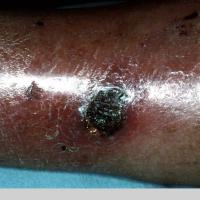 
	Ecthyma gangrenosum