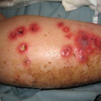 
	Ecthyma gangrenosum 
	&nbsp;