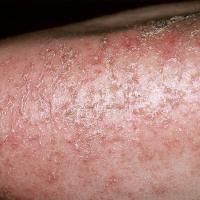 
	Asteatotic eczema

	Minimal erythema