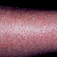 
	Asteatotic eczema

	Significant erythema