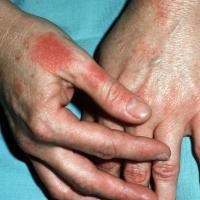 
	Latex allergy (contact urticaria)

	A milder…