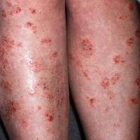 
	Discoid eczema