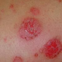 
	Discoid eczema
	
	Copied with kind permission…
