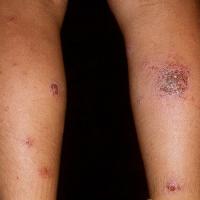 
	Discoid eczema

	Copied with kind permission…