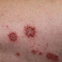 
	Discoid eczema