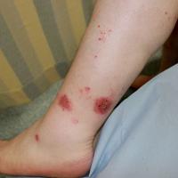 
	Discoid eczema